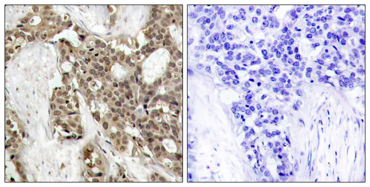 ERK1 + ERK2 Antibody - Immunohistochemistry analysis of paraffin-embedded human breast carcinoma, using p44/42 MAP Kinase (Phospho-Tyr204) Antibody. The picture on the right is blocked with the phospho peptide.