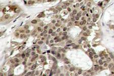 ERK1 + ERK2 Antibody - IHC of p-ERK1/2 (Y204) pAb in paraffin-embedded human breast carcinoma tissue.