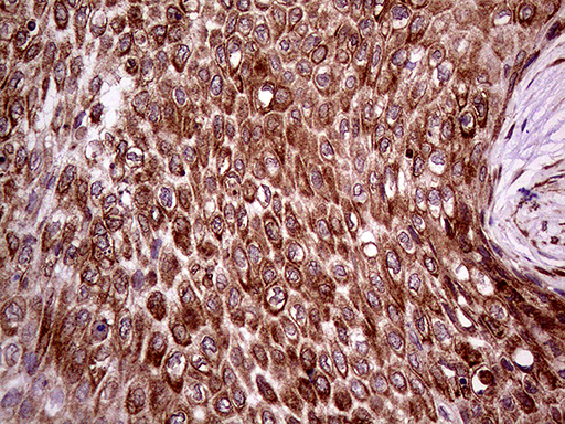 ERLIN1 / SPFH1 Antibody - Immunohistochemical staining of paraffin-embedded Carcinoma of Human bladder tissue using anti-ERLIN1 mouse monoclonal antibody. (Heat-induced epitope retrieval by 1mM EDTA in 10mM Tris buffer. (pH8.5) at 120°C for 3 min. (1:2000)