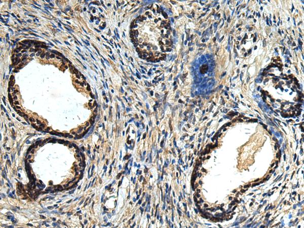 ERLIN1 / SPFH1 Antibody - Immunohistochemistry of paraffin-embedded Human prost ate cancer tissue  using ERLIN1 Polyclonal Antibody at dilution of 1:50(×200)