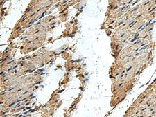 ERLIN1 / SPFH1 Antibody - Immunohistochemistry of paraffin-embedded Human thyroid cancer tissue  using ERLIN1 Polyclonal Antibody at dilution of 1:50(×200)