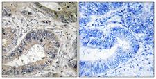 ERN2 Antibody - Immunohistochemistry analysis of paraffin-embedded human colon carcinoma tissue, using ERN2 Antibody. The picture on the right is blocked with the synthesized peptide.