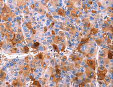 ERN2 Antibody - Immunohistochemistry of paraffin-embedded Human thyroid cancer using ERN2 Polyclonal Antibody at dilution of 1:40.