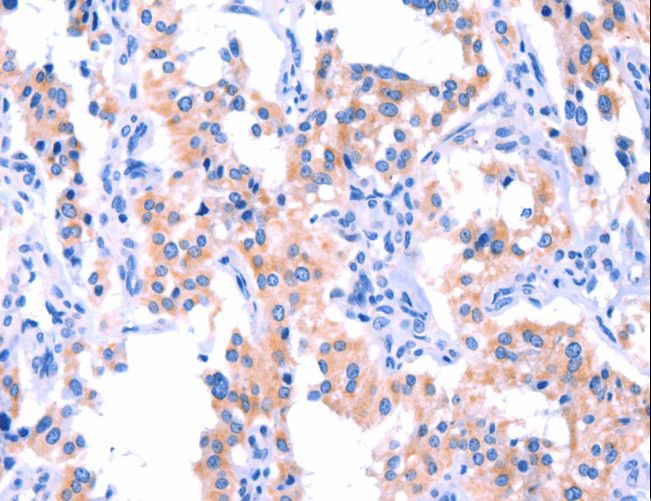 ERN2 Antibody - Immunohistochemistry of paraffin-embedded Human thyroid cancer using ERN2 Polyclonal Antibody at dilution of 1:40.