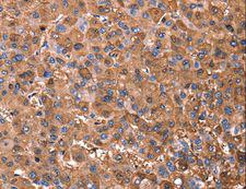 ERN2 Antibody - Immunohistochemistry of paraffin-embedded Human gastric cancer using ERN2 Polyclonal Antibody at dilution of 1:40.