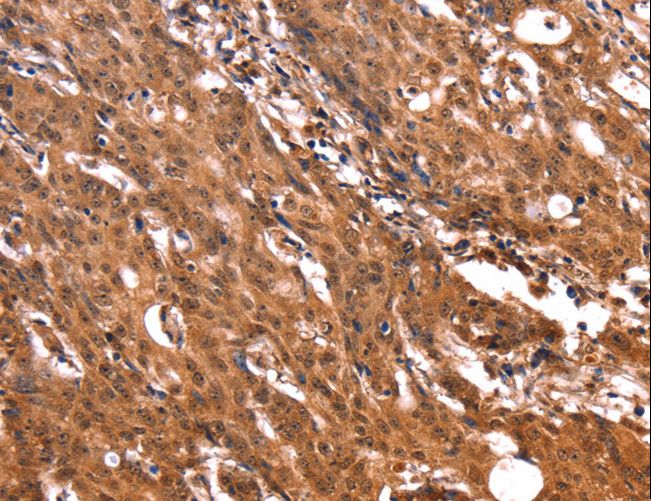 ERN2 Antibody - Immunohistochemistry of paraffin-embedded Human gastric cancer using ERN2 Polyclonal Antibody at dilution of 1:40.