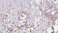 ERO1LB Antibody - 1:100 staining human liver carcinoma tissues by IHC-P. The sample was formaldehyde fixed and a heat mediated antigen retrieval step in citrate buffer was performed. The sample was then blocked and incubated with the antibody for 1.5 hours at 22°C. An HRP conjugated goat anti-rabbit antibody was used as the secondary.