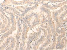 ERP27 Antibody - Immunohistochemistry of paraffin-embedded Human thyroid cancer tissue  using ERP27 Polyclonal Antibody at dilution of 1:25(×200)