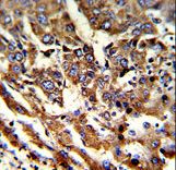 ERP29 Antibody - Formalin-fixed and paraffin-embedded human hepatocarcinoma reacted with ERP29 Antibody , which was peroxidase-conjugated to the secondary antibody, followed by DAB staining. This data demonstrates the use of this antibody for immunohistochemistry; clinical relevance has not been evaluated.