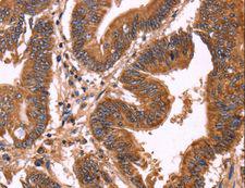 ERP29 Antibody - Immunohistochemistry of paraffin-embedded Human colon cancer using ERP29 Polyclonal Antibody at dilution of 1:40.