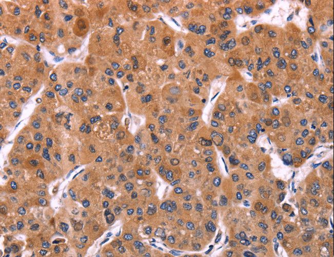 ERP29 Antibody - Immunohistochemistry of paraffin-embedded Human liver cancer using ERP29 Polyclonal Antibody at dilution of 1:40.