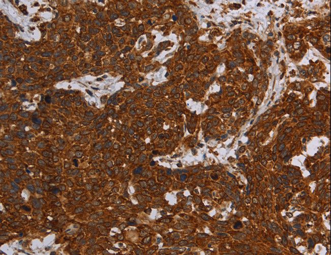 ERRFI1 / RALT Antibody - Immunohistochemistry of paraffin-embedded Human ovarian cancer using ERRFI1 Polyclonal Antibody at dilution of 1:30.