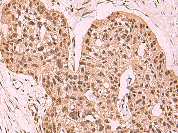 ESET / SETDB1 Antibody - Immunohistochemistry of paraffin-embedded Human esophagus cancer tissue  using SETDB1 Polyclonal Antibody at dilution of 1:60(×200)