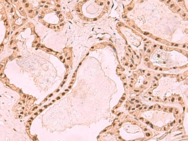 ESET / SETDB1 Antibody - Immunohistochemistry of paraffin-embedded Human thyroid cancer tissue  using SETDB1 Polyclonal Antibody at dilution of 1:60(×200)