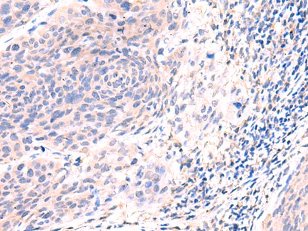 ESM1 / Endocan Antibody - Immunohistochemistry of paraffin-embedded Human cervical cancer tissue  using ESM1 Polyclonal Antibody at dilution of 1:50(×200)