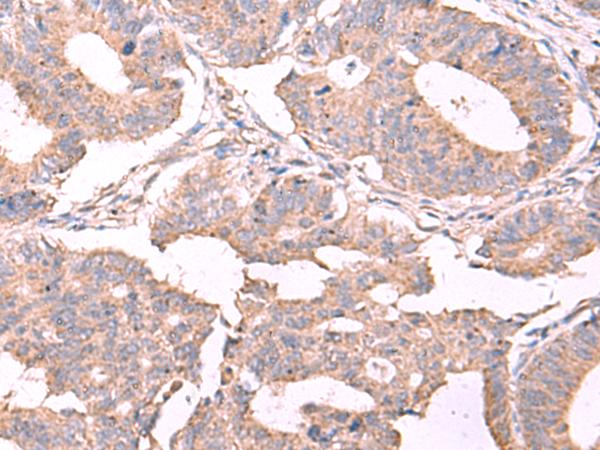 ESM1 / Endocan Antibody - Immunohistochemistry of paraffin-embedded Human colorectal cancer tissue  using ESM1 Polyclonal Antibody at dilution of 1:50(×200)