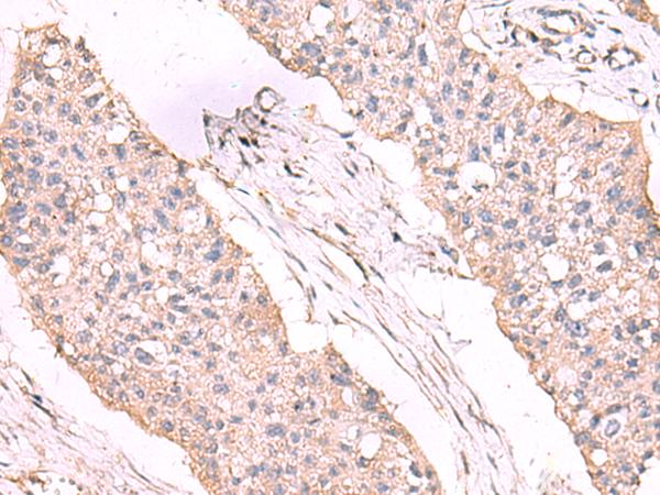 ESM1 / Endocan Antibody - Immunohistochemistry of paraffin-embedded Human esophagus cancer tissue  using ESM1 Polyclonal Antibody at dilution of 1:55(×200)