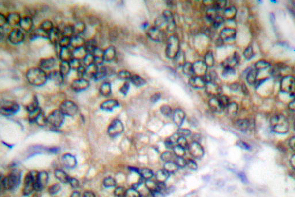 ESPL1 / Separase Antibody - IHC of Separase (A795) pAb in paraffin-embedded human colon carcinoma tissue.