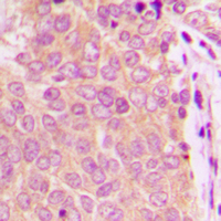 ESPL1 / Separase Antibody - Immunohistochemical analysis of Separase staining in human breast cancer formalin fixed paraffin embedded tissue section. The section was pre-treated using heat mediated antigen retrieval with sodium citrate buffer (pH 6.0). The section was then incubated with the antibody at room temperature and detected using an HRP conjugated compact polymer system. DAB was used as the chromogen. The section was then counterstained with hematoxylin and mounted with DPX.