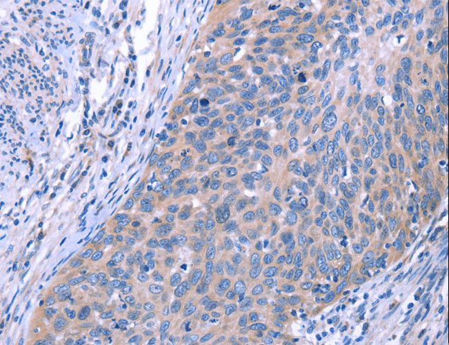 ESPL1 / Separase Antibody - Immunohistochemistry of paraffin-embedded Human cervical cancer using ESPL1 Polyclonal Antibody at dilution of 1:40.