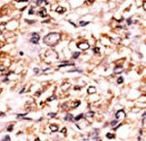 ESPL1 / Separase Antibody - Formalin-fixed and paraffin-embedded human cancer tissue reacted with the primary antibody, which was peroxidase-conjugated to the secondary antibody, followed by DAB staining. This data demonstrates the use of this antibody for immunohistochemistry; clinical relevance has not been evaluated. BC = breast carcinoma; HC = hepatocarcinoma.