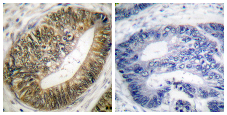 ESPL1 / Separase Antibody - Immunohistochemistry analysis of paraffin-embedded human colon carcinoma, using SEPARASE (Phospho-Ser801) Antibody. The picture on the right is blocked with the phospho peptide.