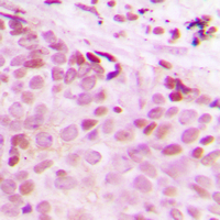 ESPL1 / Separase Antibody - Immunohistochemical analysis of Separase (pS801) staining in human breast cancer formalin fixed paraffin embedded tissue section. The section was pre-treated using heat mediated antigen retrieval with sodium citrate buffer (pH 6.0). The section was then incubated with the antibody at room temperature and detected using an HRP conjugated compact polymer system. DAB was used as the chromogen. The section was then counterstained with hematoxylin and mounted with DPX.