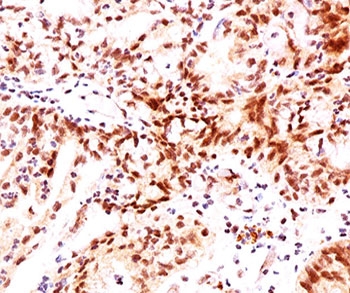 ESR2 / ER Beta Antibody - Estrogen Receptor beta antibody ERb455 immunohistochemistry ovarian cancer.  This image was taken for the unmodified form of this product. Other forms have not been tested.