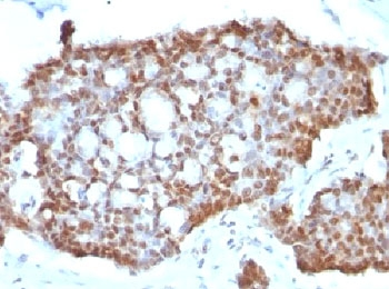 ESR2 / ER Beta Antibody - IHC testing of gastric carcinoma stained with Estrogen Receptor beta antibody (ERb455).