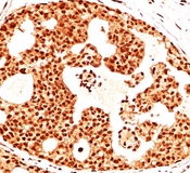 ESR2 / ER Beta Antibody - Estrogen Receptor beta antibody ERb455 immunohistochemistry breast cancer.  This image was taken for the unmodified form of this product. Other forms have not been tested.