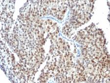 ESR2 / ER Beta Antibody - Formalin-fixed, paraffin-embedded human bladder carcinoma stained with Estrogen Receptor beta antibody (ESR2/686).  This image was taken for the unmodified form of this product. Other forms have not been tested.