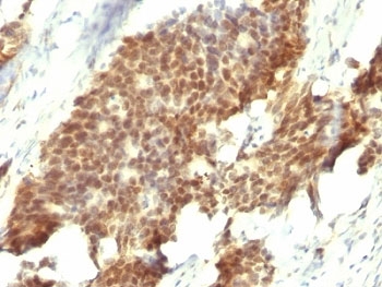 ESR2 / ER Beta Antibody - Formalin-fixed, paraffin-embedded human gastric carcinoma stained with Estrogen Receptor beta antibody (ESR2/686).  This image was taken for the unmodified form of this product. Other forms have not been tested.
