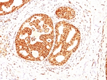 ESR2 / ER Beta Antibody - Formalin-fixed, paraffin-embedded human breast carcinoma stained with Estrogen Receptor beta antibody (ESR2/686).  This image was taken for the unmodified form of this product. Other forms have not been tested.