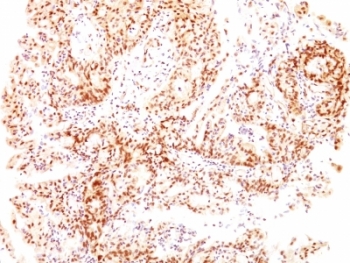 ESR2 / ER Beta Antibody - Formalin-fixed, paraffin-embedded human ovarian carcinoma stained with Estrogen Receptor beta antibody (ESR2/686).  This image was taken for the unmodified form of this product. Other forms have not been tested.