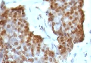 ESR2 / ER Beta Antibody - IHC testing of ovarian cancer stained with Estrogen Receptor beta antibody (ERb455).  This image was taken for the unmodified form of this product. Other forms have not been tested.