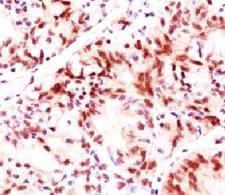 ESR2 / ER Beta Antibody - IHC testing of breast cancer stained with Estrogen Receptor beta antibody (ERb455).  This image was taken for the unmodified form of this product. Other forms have not been tested.