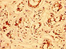 ESRP2 / RBM35B Antibody - Immunohistochemistry image at a dilution of 1:300 and staining in paraffin-embedded human breast cancer performed on a Leica BondTM system. After dewaxing and hydration, antigen retrieval was mediated by high pressure in a citrate buffer (pH 6.0) . Section was blocked with 10% normal goat serum 30min at RT. Then primary antibody (1% BSA) was incubated at 4 °C overnight. The primary is detected by a biotinylated secondary antibody and visualized using an HRP conjugated SP system.