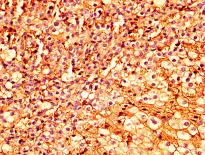 ESRP2 / RBM35B Antibody - Immunohistochemistry image at a dilution of 1:300 and staining in paraffin-embedded human human adrenal gland tissue performed on a Leica BondTM system. After dewaxing and hydration, antigen retrieval was mediated by high pressure in a citrate buffer (pH 6.0) . Section was blocked with 10% normal goat serum 30min at RT. Then primary antibody (1% BSA) was incubated at 4 °C overnight. The primary is detected by a biotinylated secondary antibody and visualized using an HRP conjugated SP system.