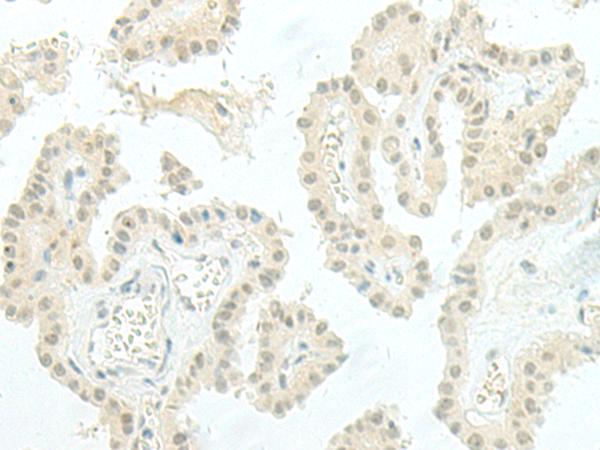 ESRP2 / RBM35B Antibody - Immunohistochemistry of paraffin-embedded Human thyroid cancer tissue  using ESRP2 Polyclonal Antibody at dilution of 1:95(×200)