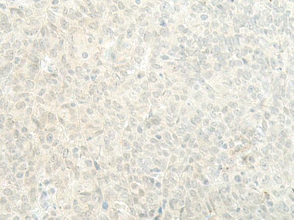 ESRP2 / RBM35B Antibody - Immunohistochemistry of paraffin-embedded Human ovarian cancer tissue  using ESRP2 Polyclonal Antibody at dilution of 1:95(×200)