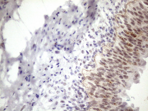 ESRRA / ERR Alpha Antibody - Immunohistochemical staining of paraffin-embedded Carcinoma of Human prostate tissue using anti-ESRRA mouse monoclonal antibody. (Heat-induced epitope retrieval by 1mM EDTA in 10mM Tris buffer. (pH8.5) at 120 oC for 3 min. (1:150)