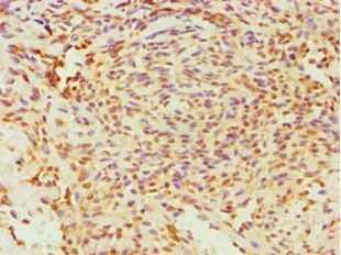 ESRRA / ERR Alpha Antibody - Immunohistochemistry of paraffin-embedded human breast cancer using antibody at 1:100 dilution.