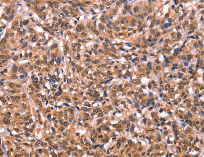 ESRRB / ERR Beta Antibody - Immunohistochemistry of paraffin-embedded Human liver cancer using ESRRB Polyclonal Antibody at dilution of 1:40.