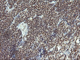 ESRRG / ERR Gamma Antibody - IHC of paraffin-embedded Human lymphoma tissue using anti-ESRRG mouse monoclonal antibody.