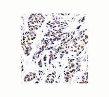 Estrogen Receptor Antibody - Estrogen Receptor antibody ER506 immunohistochemistry.  This image was taken for the unmodified form of this product. Other forms have not been tested.