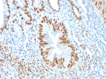 Estrogen Receptor Antibody - IHC testing of human breast invasive ductal carcinoma with ER antibody (ER506).