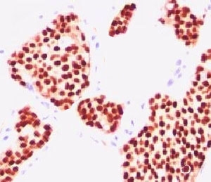 Estrogen Receptor Antibody - IHC testing of human breast carcinoma stained with Estrogen receptor antibody (NR3Ga-1).  This image was taken for the unmodified form of this product. Other forms have not been tested.