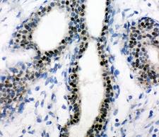 Estrogen Receptor Antibody - IHC-P: Estrogen Receptor antibody testing of human breast cancer tissue