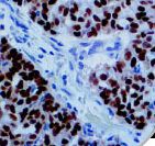 Estrogen Receptor Antibody - IHC of Estrogen Receptor on FFPE Breast Carcinoma Tissue.
