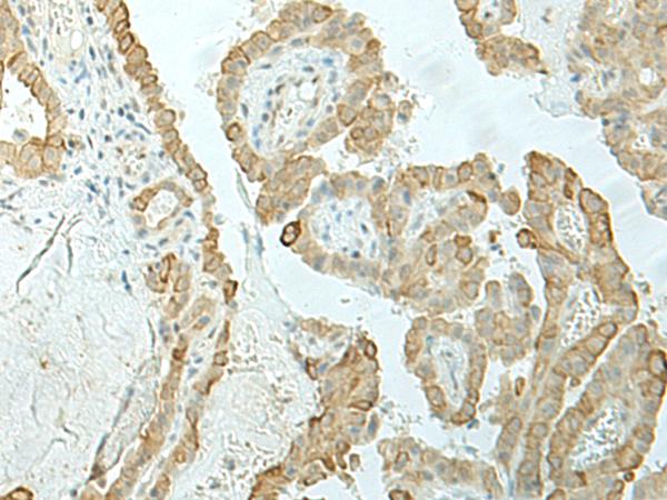 ETAA1 Antibody - Immunohistochemistry of paraffin-embedded Human thyroid cancer tissue  using ETAA1 Polyclonal Antibody at dilution of 1:25(×200)